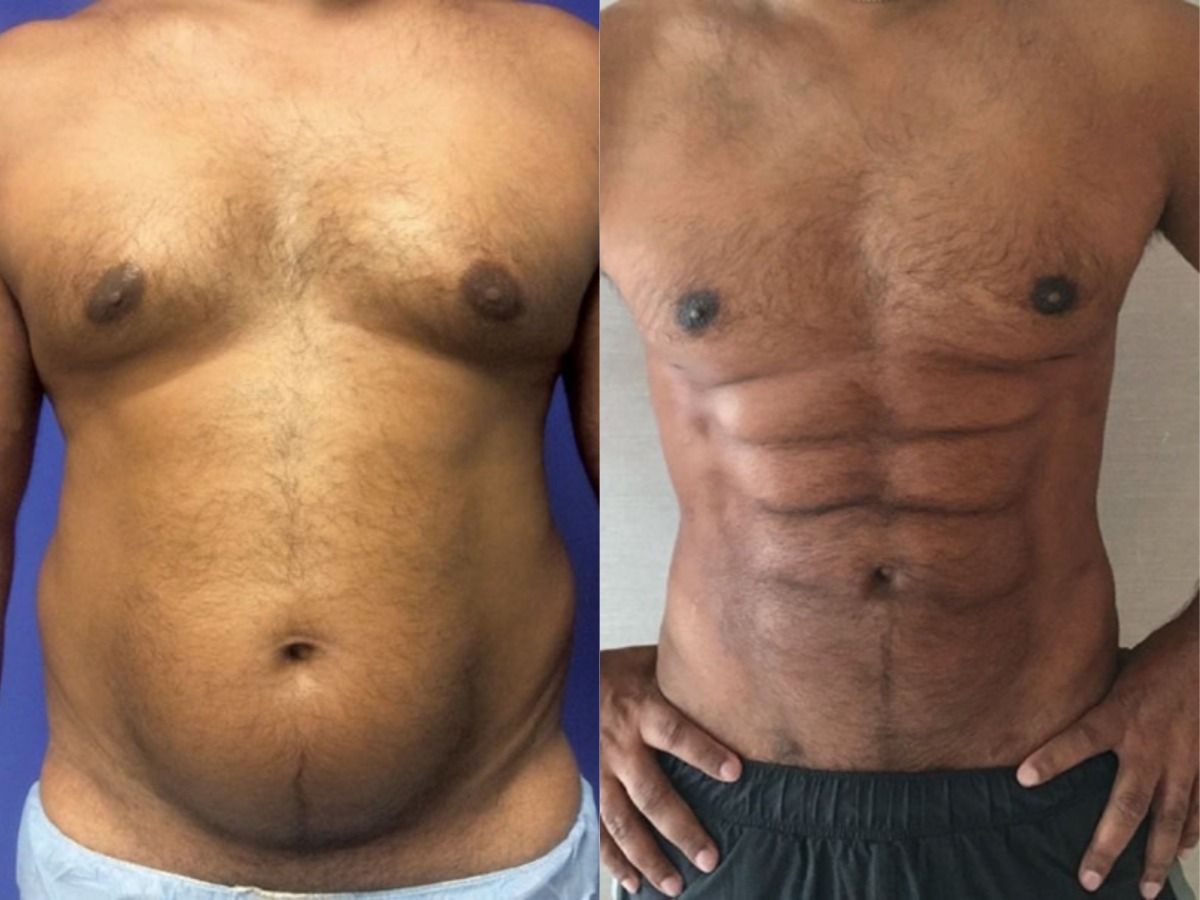 Fat abdominal after before. 6 Pack which fat percent.