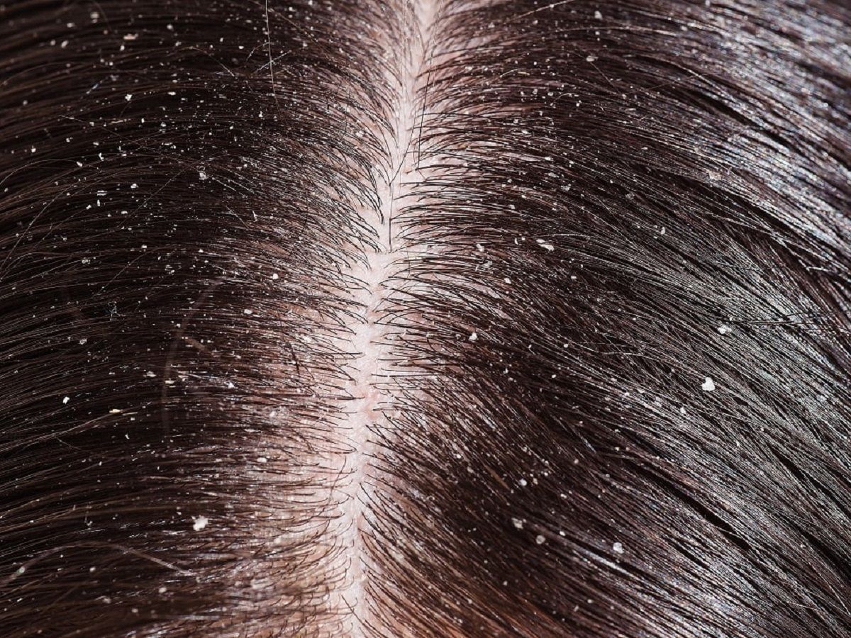 Flaky Scalp Fixes  Battle of the flakes  Huge dandruff flakes  Embedded  Flakes