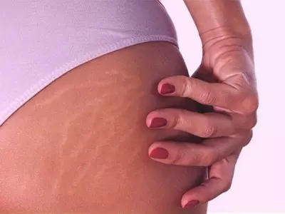 difference between red and white stretch marks