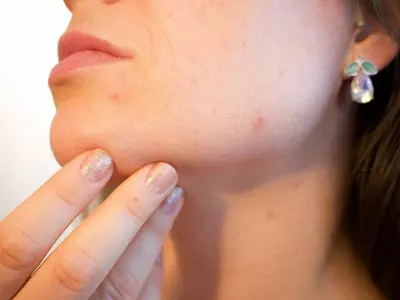 period acne
