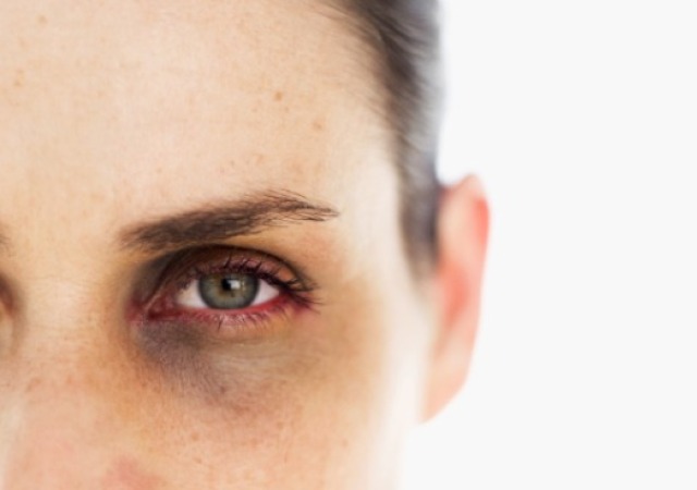 The Truth About Dark Circles: Causes and Links to Diseases