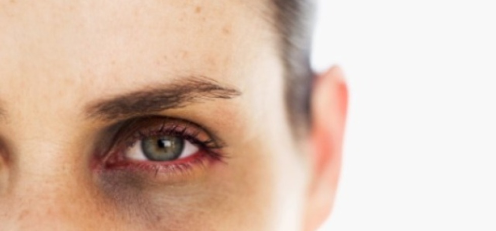 The Truth About Dark Circles: Causes and Links to Diseases