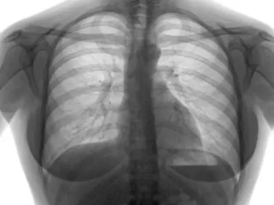 spinal tuberculosis