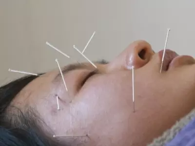Science Behind Acupuncture Revealed
