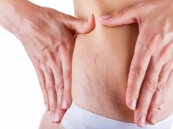 Stretch Marks: Causes, Treatment, Prevention