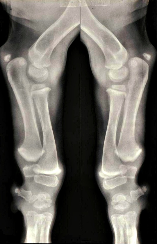 new-treatment-found-for-brittle-bone-disease