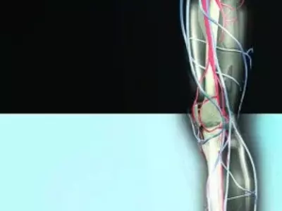 Stem Cell Implants can Fix Broken Bones
