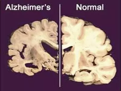 Alzhimers