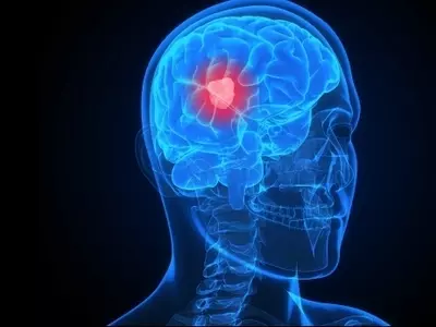 New Target for Therapy Found in Brain Tumours
