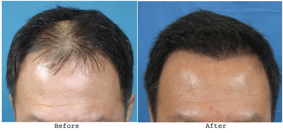 Hair Care Hair Treatments To Fight Baldness In Men Healthy Living