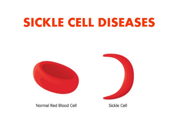 What is Sickle Cell Diseases | Healthy Living