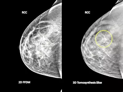3D Breast Imaging to Revolutionize Cancer Screening