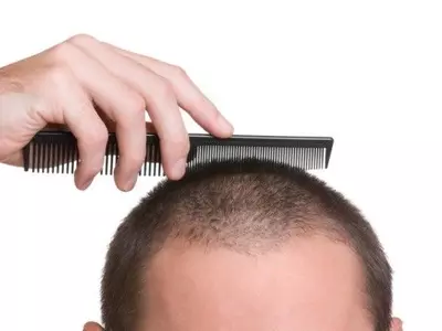 Hair loss