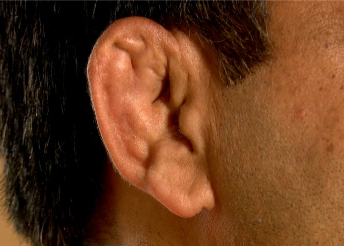 Have You Ever Wondered Why Wrestlers Have Disfigured Ears?