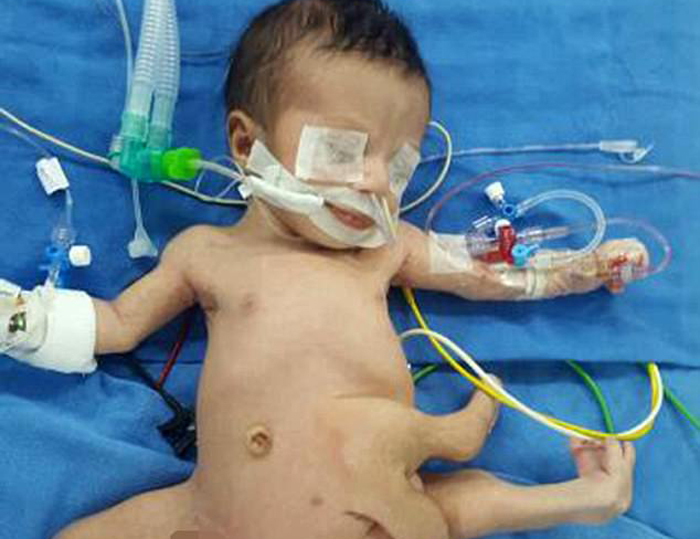 Doctors Save A Baby With A Rare Condition By Successfully Removing The