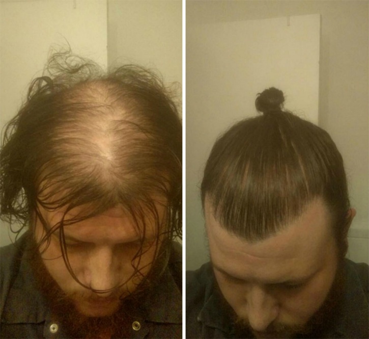 Hiding That Bald Patch With A Man Bun? Well, You Could Be Risking