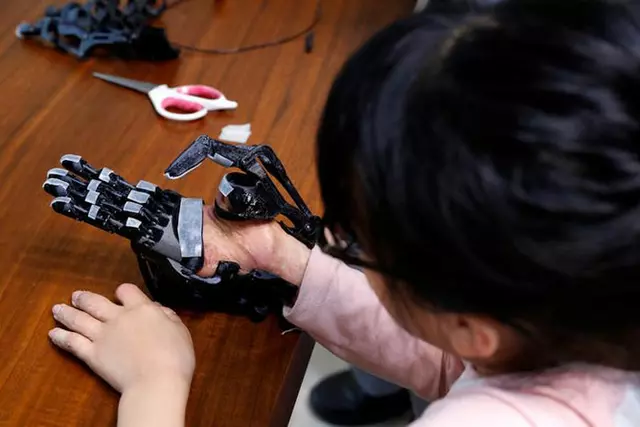 Engineering student in Singapore gets 3D-printed finger after bike accident
