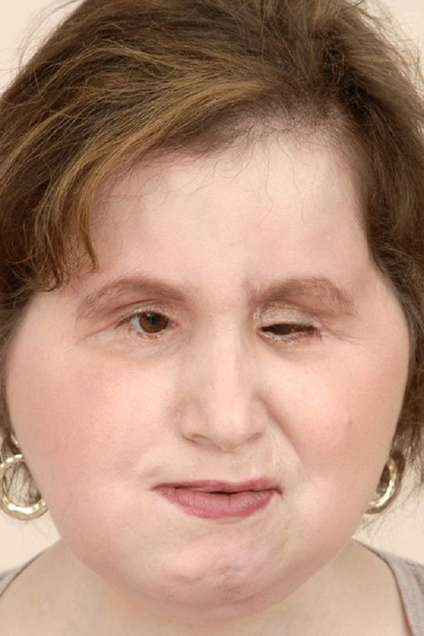 21 Yo Becomes Youngest Us Recipient Of Full Face Transplant After Self Inflicted Gunshot Wound
