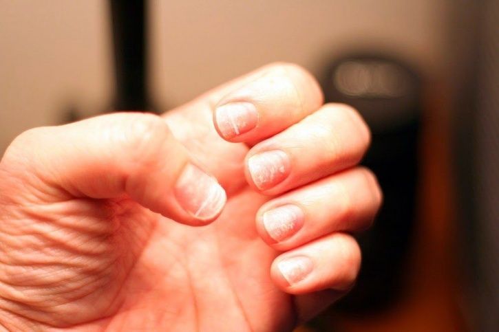 Skin Concerns] Dry, cracking, peeling skin around fingernails :  r/SkincareAddiction