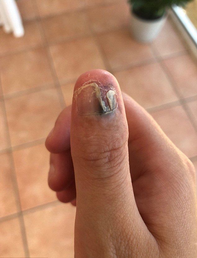 Biting my nails caused CANCER Biting my nails caused CANCER