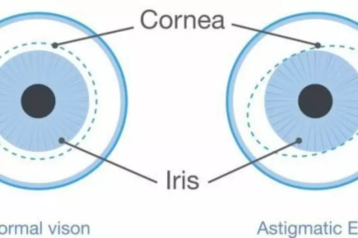 Astigmatism Astigmatism