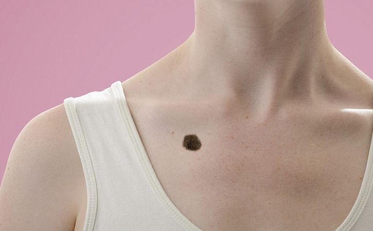 शरीर के Til ka matlab | Mole Meaning in hindi: किसी भी भाग पर मौजूद तिल