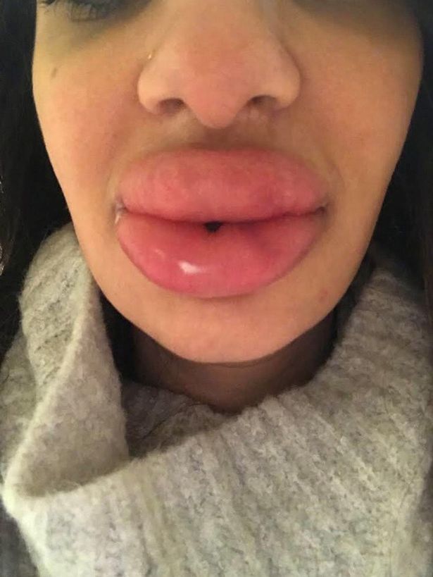 Sarah Najjar Got A Lip Procedure Done But It Went Wrong And Gave Her Lumpy Swollen Lips