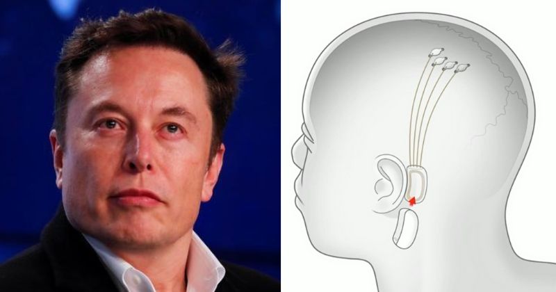 Elon Musk's Neuralink Brain Implant Will Be Ready By December 2020, And Give You Superpowers