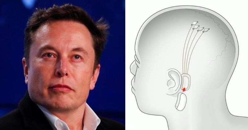 Elon Musks Neuralink Brain Implant Will Be Ready By December 2020 And