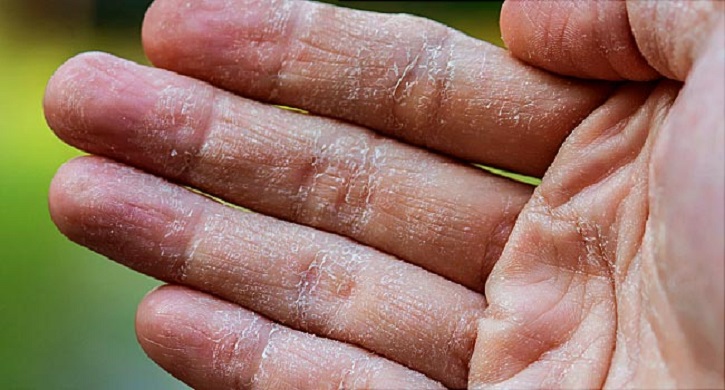 Excessive Use Of Hand Sanitiser Leads To Hand Dermatitis 