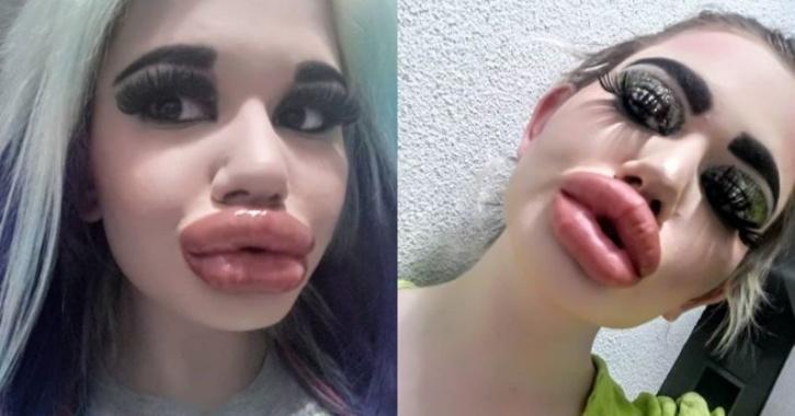 Andrea Ivanova Wants The Biggest Lips In The World, Has Had Lip Fillers Injected 20 Times