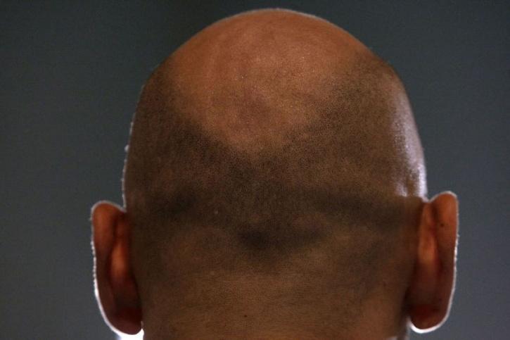 Man Hides Baldness From Wife She Registers Police Case Against Him
