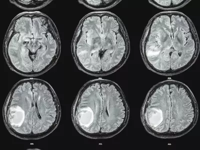Israeli Scientists Find Major Breakthrough In Curing Lethal Brain Cancer