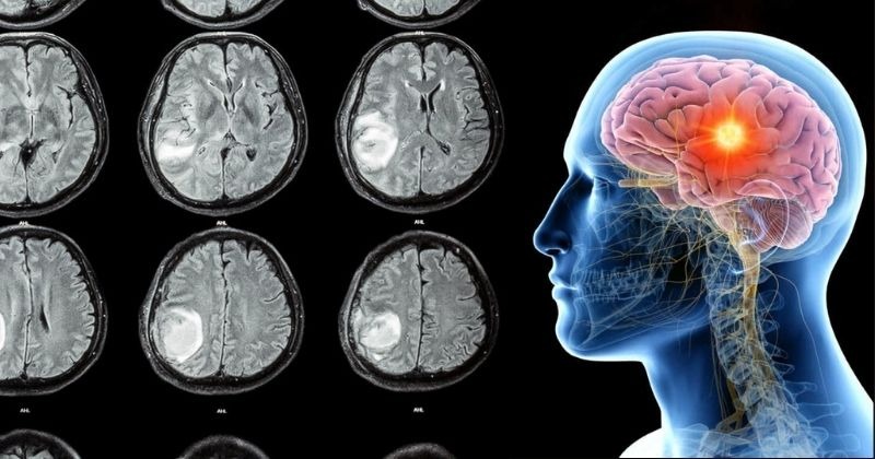 Israeli Scientists Find Huge Breakthrough In Curing Deadly Brain Cancer