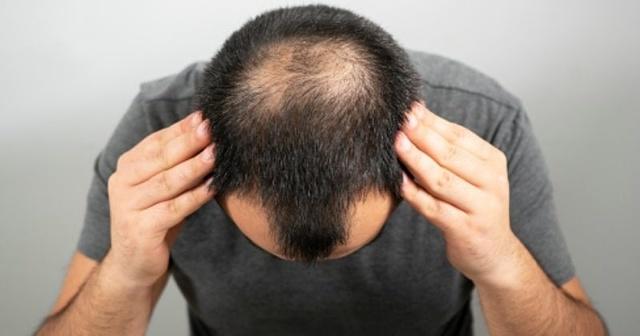 Scientists Find Cure For Male Baldness Using A Micro-Needle Patch Scientists Find Cure For Male Baldness Using A Micro-Needle Patch