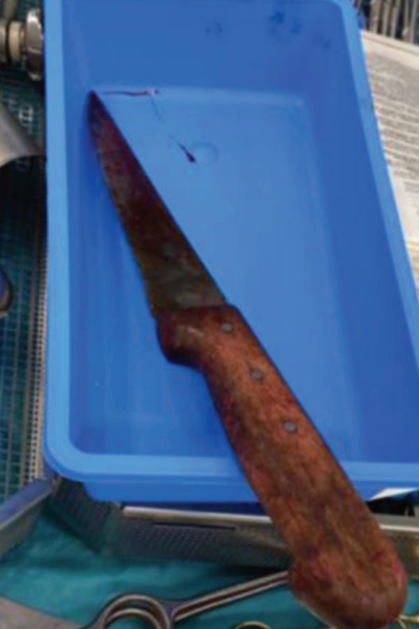 Woman Has Knife Stuck In Abdomen While Gardening