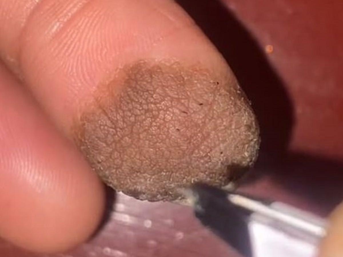 Woman's Finger Has Pubic Hair Growing Out Of It
