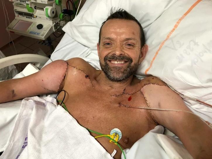 World S First Double Arm Transplant Patient Can Now Flex His New Biceps