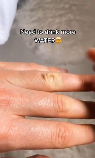 Doctors Skin Pinch Test Will Tell You If Youre Dehydrated 0648