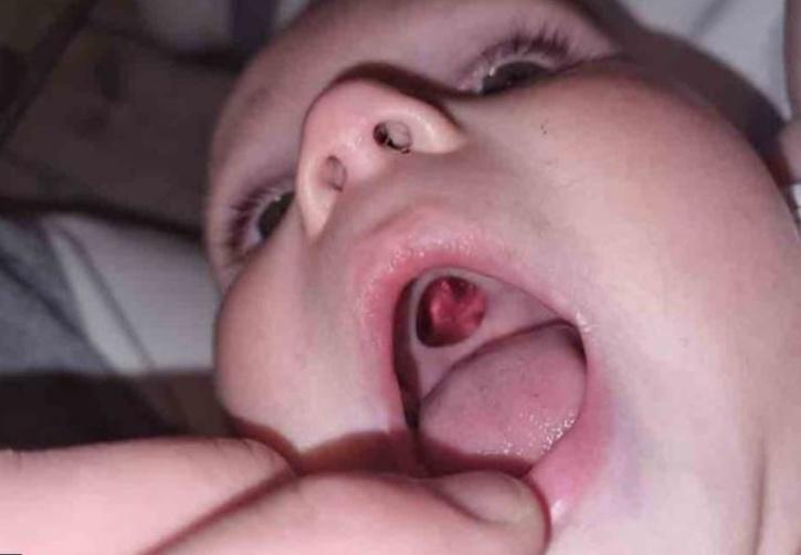 The couple dashed to the hospital and reached out to the medics for immediate attention. All the while the young mother was inconsolable with the idea of her son having a hole in his mouth.