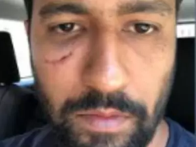 The Scar On Vicky Kaushal's Face In 'Sardar Udham' Is Real; He Got 13 Stitches Due To An Injury