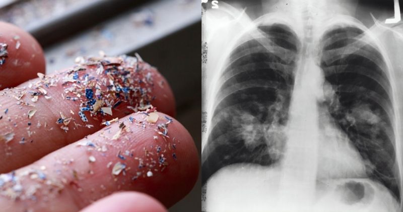 Microplastics Found Deep Inside The Lungs Of Living People For The ...