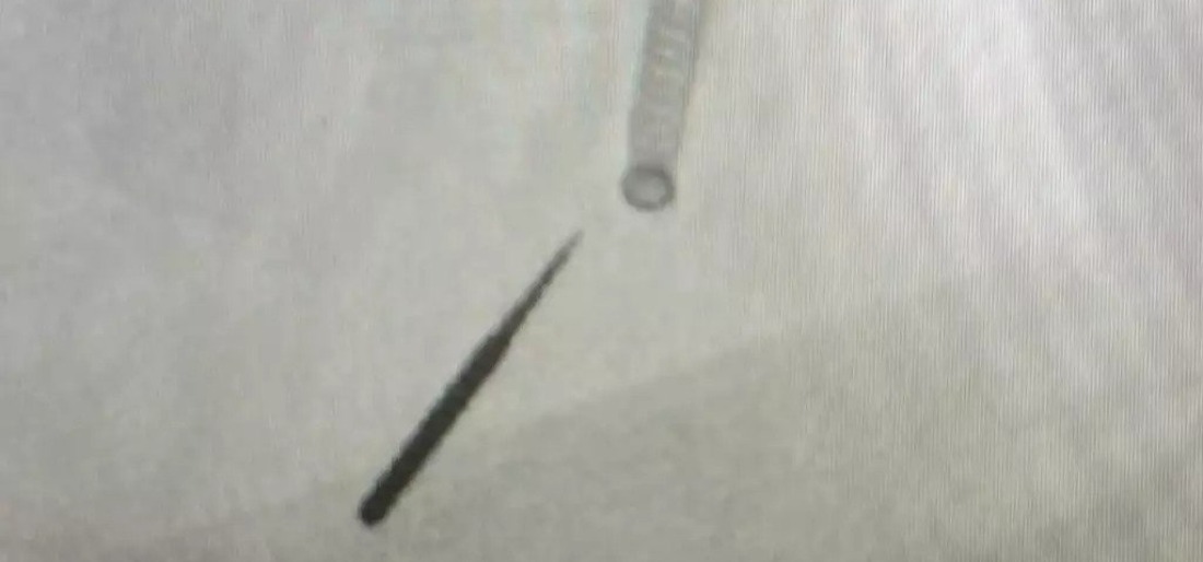 Man Accidentally Inhales Drill Bit Into Lung During Routine Dental