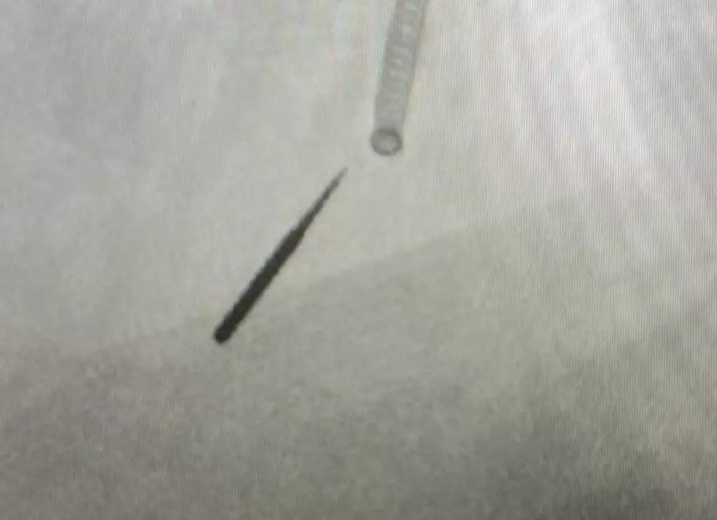 Man Accidentally Inhales Drill Bit Into Lung During Routine Dental