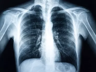 AI That Scans X-Rays For Abnormalities Without Humans Approved For Use In EU