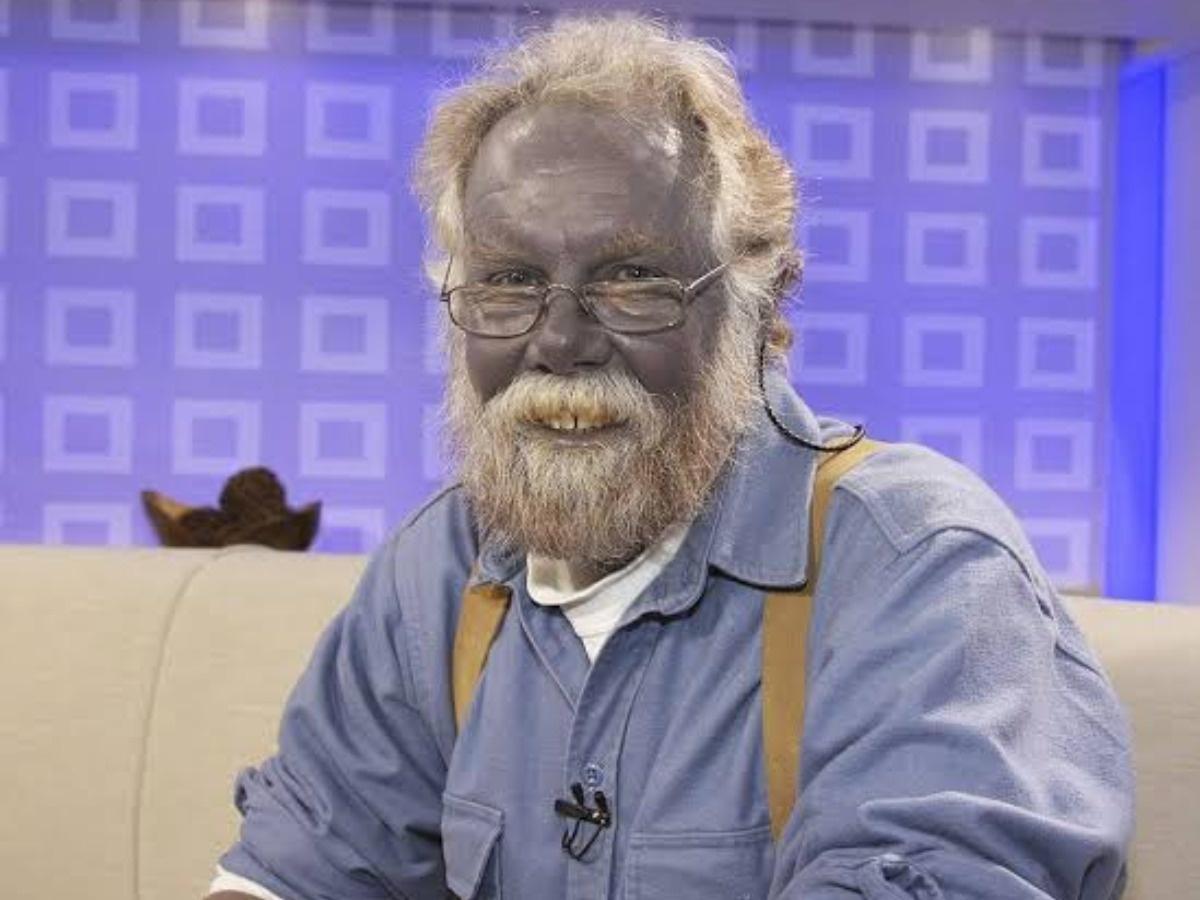 The man who turned blue after taking a dietary supplement for years