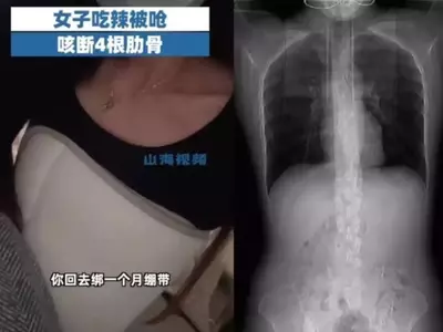Chinese Woman Breaks Ribs From Coughing