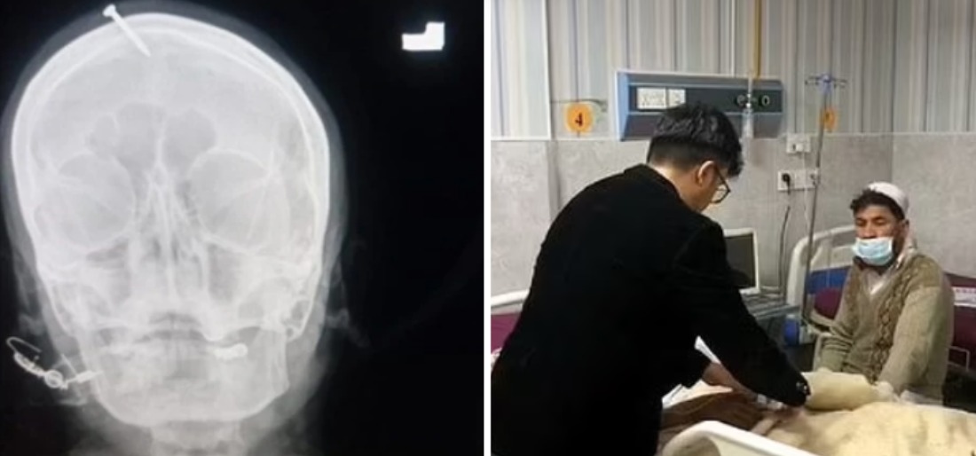Two Inch Nail Hammered Into Pakistani Pregnant Woman's Head