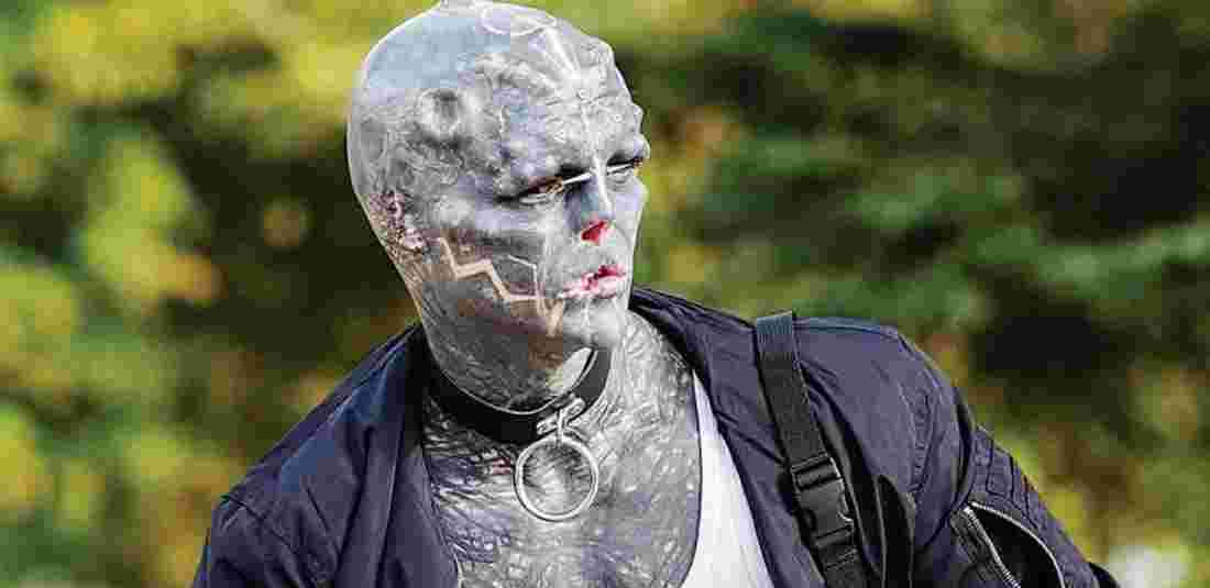 ‘Black Alien’ Plans To Have Leg Amputated
