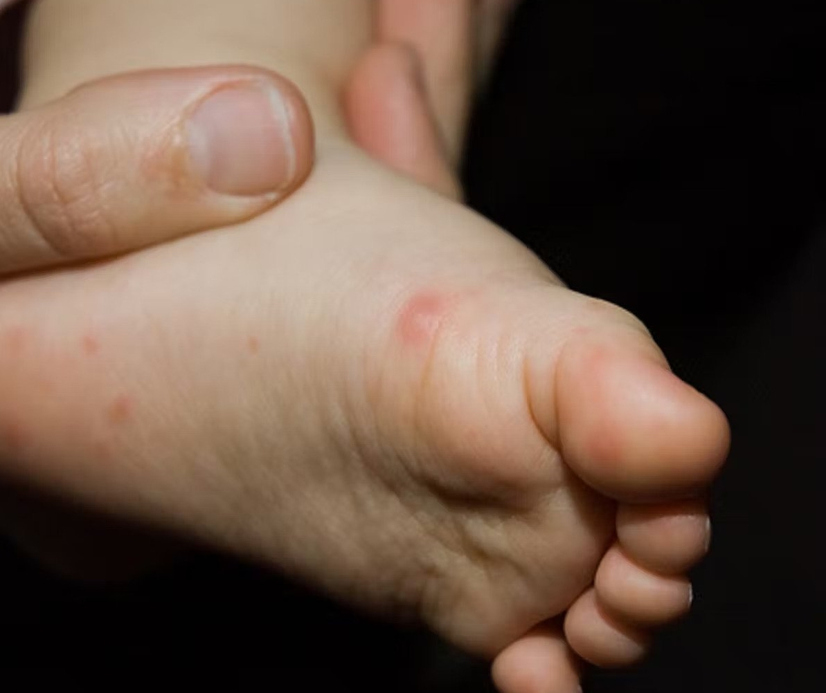 Amid Rising Monkeypox Cases, Hand, Foot, And Mouth Disease Reported ...